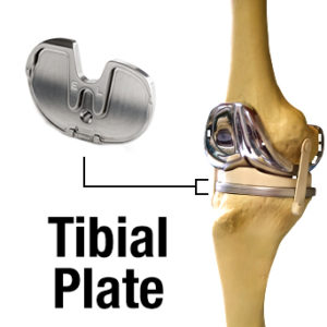 knee replacement issues